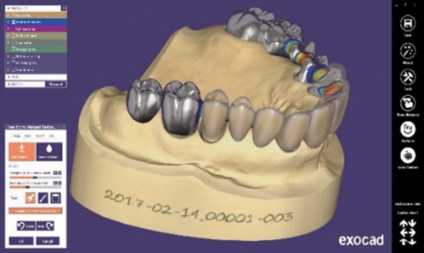 Exocad DentalCAD Flex Software